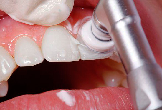 Às vezes, antes do tratamento da cárie dentária, é necessária uma higiene bucal profissional.