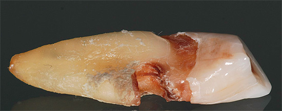Dente com raiz de cárie