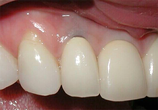 Com o desenvolvimento prolongado de cárie sob a raiz da gengiva pode ser tão afetado que o dente precisa ser removido.