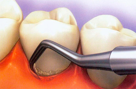Nos bolsos entre a gengiva e o dente, resíduos alimentares e microrganismos cariogênicos podem se acumular.