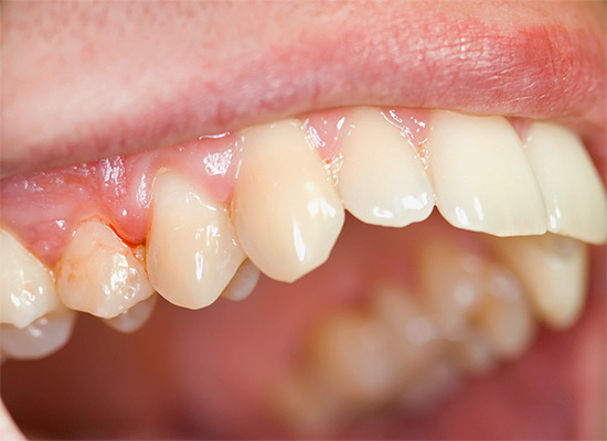 Muitas vezes, os pacientes se queixam nem de um dente, mas de dor na gengiva