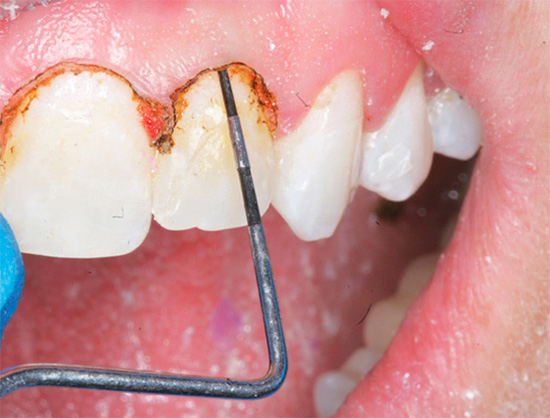 No tratamento de cárie localizada sob a gengiva, muitas vezes é necessária a excisão de tecidos moles adjacentes ao dente.