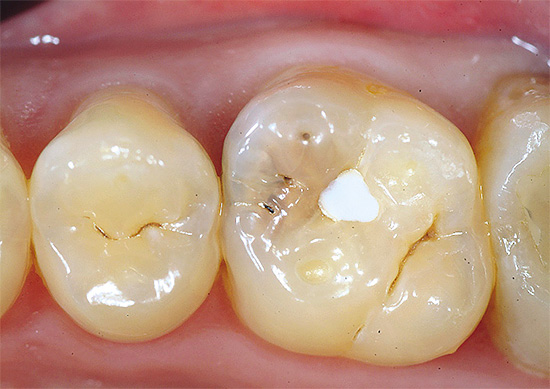 Às vezes, cimentos de ionômero de vidro são usados ​​no tratamento de cárie profunda (o dente é mostrado na foto antes do tratamento)