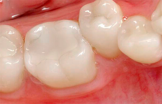 Às vezes, após a instalação do preenchimento, pode ser sentida uma dor no dente (sensibilidade pós-preenchimento).