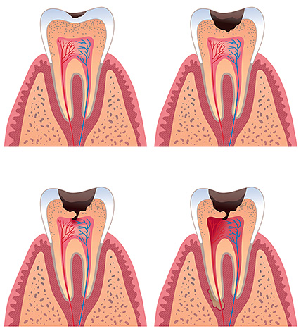 À medida que o processo carioso se desenvolve, a cavidade se aproxima da polpa do dente.