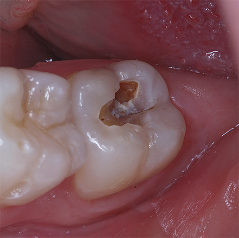 Se o tratamento da cárie profunda não for iniciado a tempo, pode atingir a polpa do dente (para o nervo).