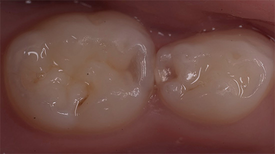Foto de um dente antes de encher