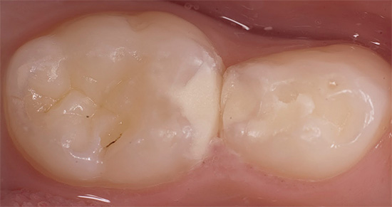 Depende muito de quão bem o tratamento dentário é realizado - se o selo não for instalado corretamente, também poderá ocorrer cárie profunda (secundária) sob ele.