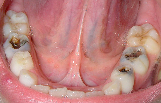 Três dentes com lesões profundas de cárie são claramente visíveis na foto.