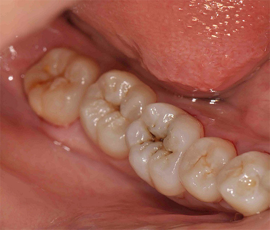 Esistono diversi metodi per diagnosticare la carie, il più efficace dei quali prenderemo in considerazione ulteriormente.