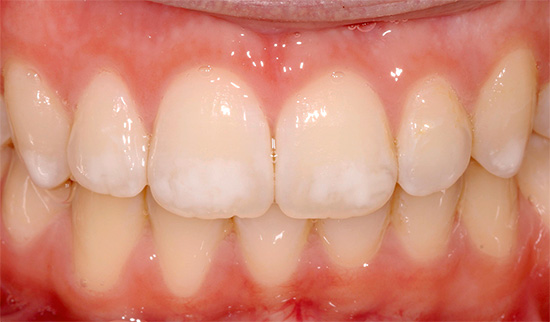 La foto mostra un esempio di fluorosi: ci sono molte macchie bianche sui denti, ma questa non è carie
