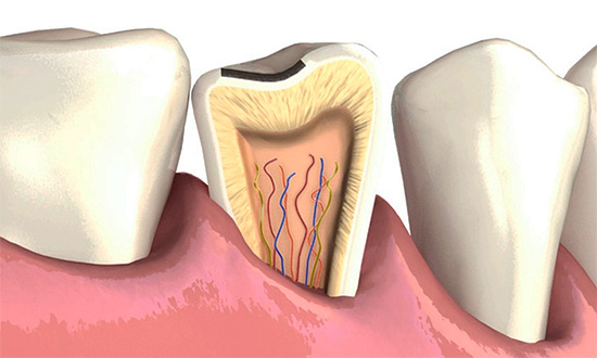 Se ci sono trucioli significativi sullo smalto, è importante guarirli in tempo, poiché attraverso di essi è possibile sviluppare un processo cariato in profondità nel dente.