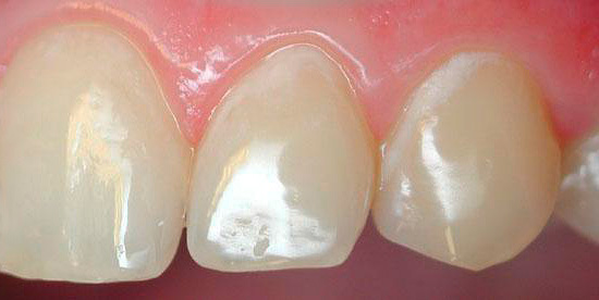 Non tutte le persone che trovano tali macchie bianche sui denti si renderanno conto che si tratta di carie