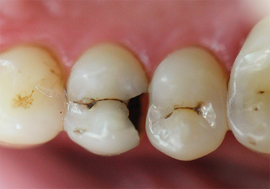 È molto più facile per una persona normale diagnosticare una carie molto avanzata, quando i denti iniziano già a provare dolore da varie influenze.
