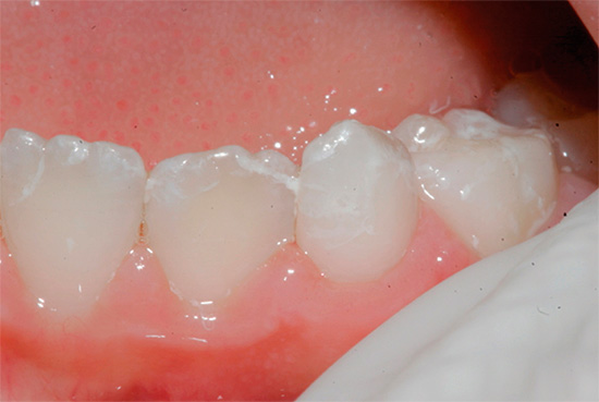 L'ispezione visiva dei denti è un metodo molto efficace per diagnosticare la carie e un dentista esperto può facilmente riconoscere anche le sue manifestazioni iniziali.
