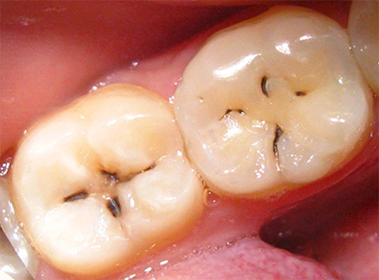 Un esempio di carie visivamente chiaramente distinguibili sotto forma di macchie e strisce scure nella zona della fessura del dente.