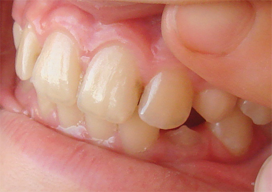 La diagnostica termica viene spesso utilizzata per valutare la profondità della carie di un dente.
