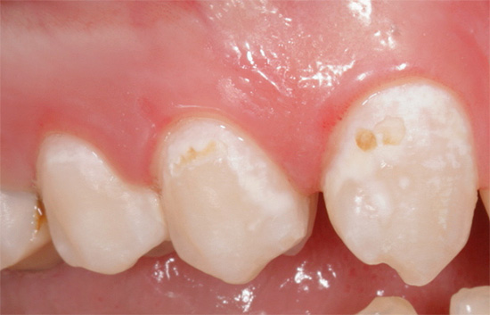 Con la carie iniziale nella fase di un punto bianco e persino altamente pigmentato, il trattamento dentale può spesso essere eseguito con metodi conservativi, è importante solo iniziare in tempo ...