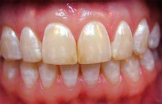 Più punti biancastri, situati simmetricamente sui denti con lo stesso nome, sono caratteristici della fluorosi.