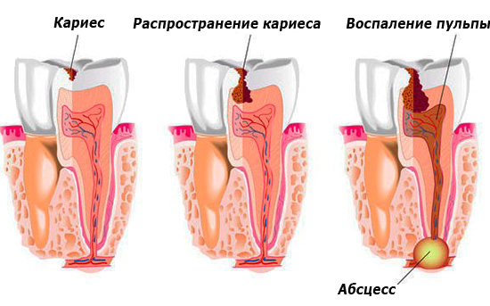 L'immagine mostra la diffusione della carie in profondità nel dente, seguita dall'infiammazione alla radice