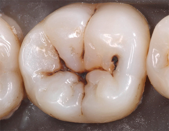 Carie iniziale nella fase di una macchia scura (pigmentata) nelle fessure del dente