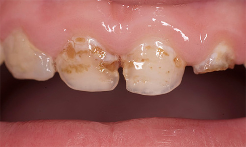 A exposição prolongada a ácidos no esmalte do dente leva à sua desmineralização e subsequentemente à cárie dentária