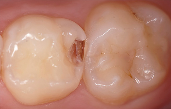 A presença de microrganismos cariogênicos na cavidade oral não significa que ocorra cárie dentária