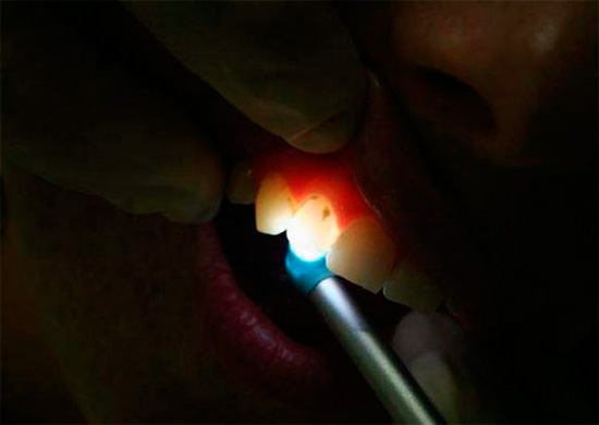 La transilluminazione come metodo per diagnosticare la carie latente consiste nell'illuminare il dente con una luce intensa, mentre le zone cariate possono essere facilmente rilevate grazie alla loro minore trasparenza.
