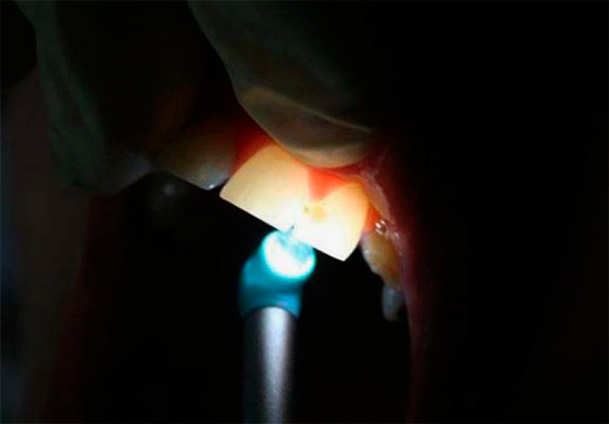 Quando il dente è illuminato, l'area interessata dalla carie diventa chiaramente visibile.
