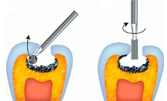 Un esempio della preparazione di cavità nella regione della fessura del dente