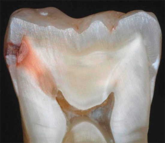 La foto mostra un esempio di come appare la carie nascosta su un taglio di un dente reale: in precedenza, la regione cariata era nascosta nel punto di contatto dei denti vicini e non emetteva nulla.