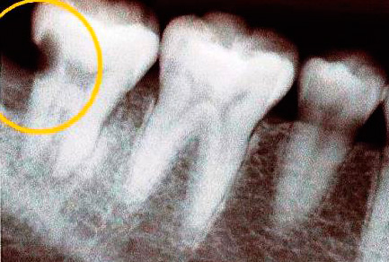 Sulla radiografia, una cavità cariata nel dente è chiaramente visibile.