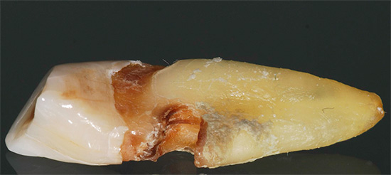 La foto mostra un esempio quando la carie nascosta nell'area della radice del dente alla fine ha portato alla necessità di rimuoverlo.