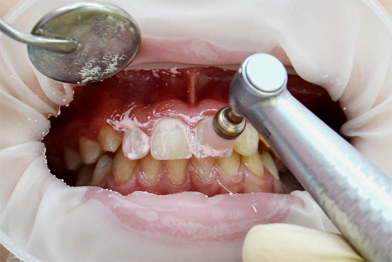 Limpeza mecânica dos dentes antes de serem tratados com remineralizante