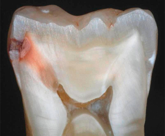 Se il trattamento non viene avviato in tempo, la carie distruggerà lo strato di smalto e penetrerà all'interno del dente, fino alla dentina e quindi nella camera della polpa ...