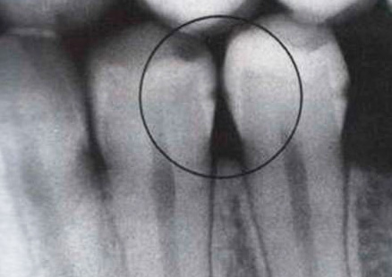 Un esempio di una radiografia dei denti: è visibile la presenza di carie interdentale nascoste