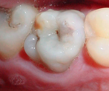 I punti neri nella regione della fessura del dente a volte portano alla cavità cariata interna