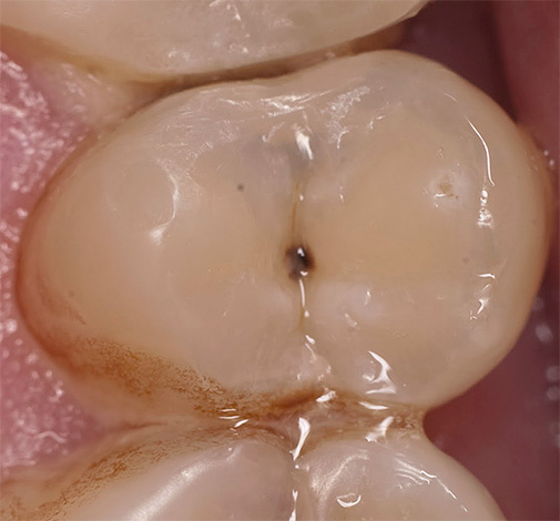 Un altro esempio, quando sono necessari ulteriori strumenti diagnostici per chiarire se vi sono carie nascoste all'interno del dente.