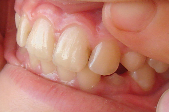 Lesione cariata nello spazio interdentale (carie interdentale)