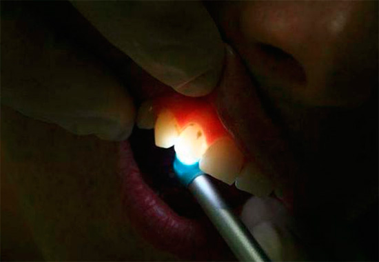 La transilluminazione con luce intensa rivela aree cariate a causa della loro minore trasparenza