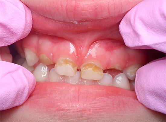 Carie in bottiglia sui denti da latte del bambino