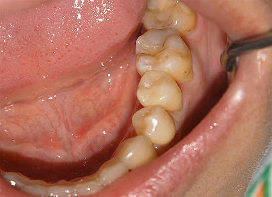 I denti con carie cronica possono assomigliare a questo: sono visibili più tracce minori di lesioni, di solito non disturbano la persona.