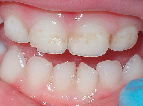Ai primi segni di demineralizzazione dello smalto dei denti, è necessario contattare il dentista, evitando così che il processo vada in forma acuta.
