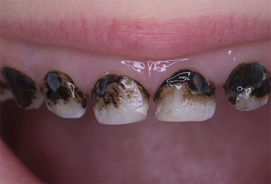 La foto mostra un esempio di denti argentati (tuttavia, questa procedura non salva sempre dalla carie)
