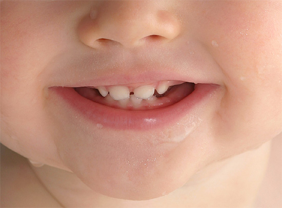 La prevenzione della carie dovrebbe iniziare immediatamente dopo l'eruzione dei primi denti in un bambino.