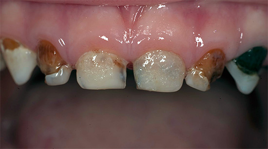 Un esempio di carie generalizzata dei denti da latte in un bambino.