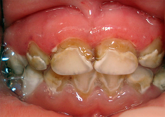 Decadimento cariato di denti decidui