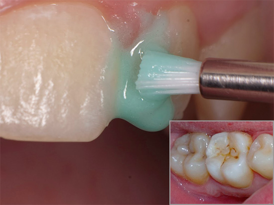 Às vezes, é realmente possível curar um dente afetado por cárie em casa, mas nessa questão difícil existem várias nuances importantes ...