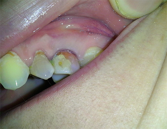 Na tentativa de curar a cárie dentária com peróxido de hidrogênio, apenas manchas irregulares do dente podem ser alcançadas, e também é possível queimar a mucosa oral.