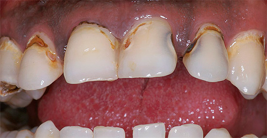 Por estranho que pareça, as conspirações às vezes parecem reduzir a dor de dente, mas a cárie em si não desaparece e, no futuro, os problemas só aumentarão.